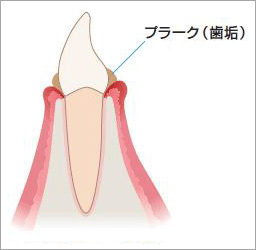 プラーク（歯垢）