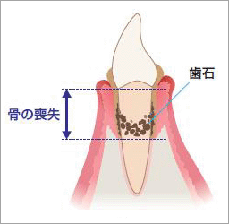 歯石