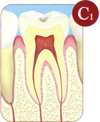 ナメル質（歯の表面）の小さな虫歯