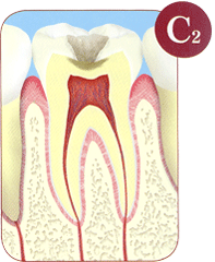 象牙質まで進んだ虫歯