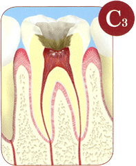 神経まで進んだ虫歯