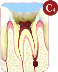 歯根だけ残っている虫歯