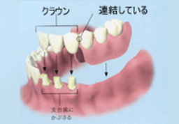 アタッチメントタイプ