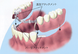 アタッチメントタイプ アタッチメントタイプ