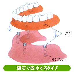 磁石で止めるタイプのインプラントオーバーデンチャー