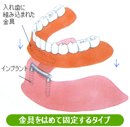 金具をはめて止めるタイプのインプラントオーバーデンチャー