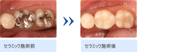 セラミック施術前と施術後