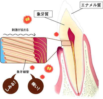 知覚過敏