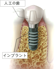 インプラント インプラント