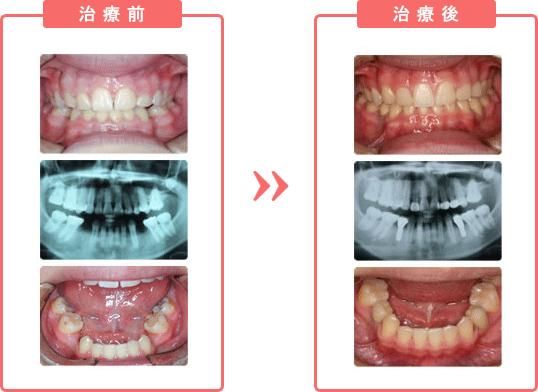 インプラント治療の目的 インプラント治療の目的