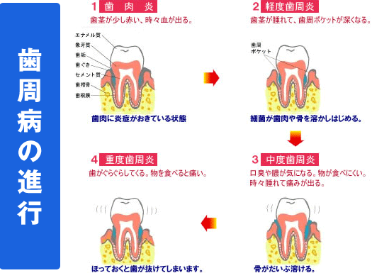 歯周病の進行 歯周病の進行