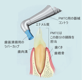 PMTC（Professional Mechanical Tooth Cleaning）