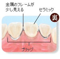 金属焼付ポーセレン