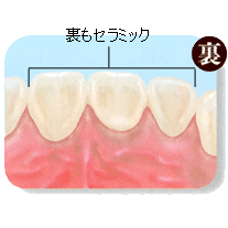 オールセラミックス オールセラミックス