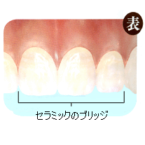 オールセラミックス オールセラミックス
