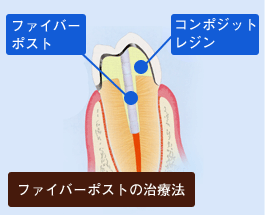 ファイバーコア ファイバーコア